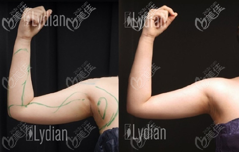 韩国丽迪安手臂吸脂实例图 韩国丽迪安手臂吸脂实例图