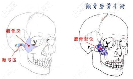吴昌铉面部轮廓整形 吴昌铉面部轮廓整形