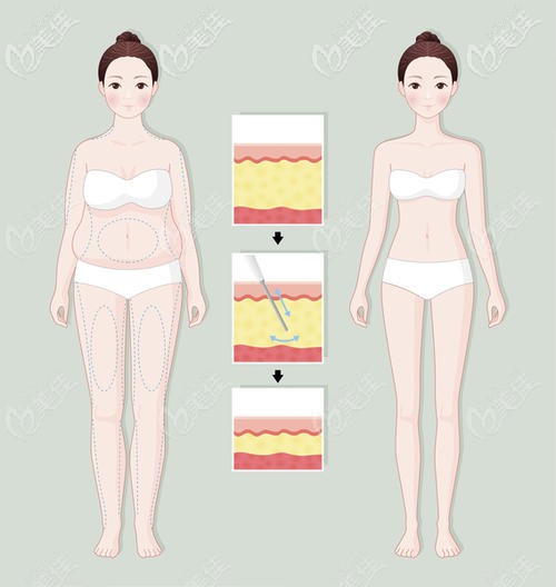 南京康美3月全身吸脂价格下调，调价幅度较大的腰腹环吸1万多就能做