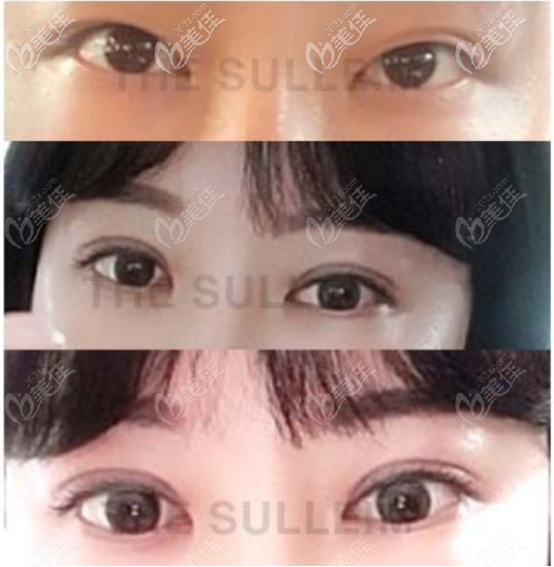 韩国Sulleim心动整形医院双眼皮整形案例一 韩国Sulleim心动整形医院双眼皮整形案例一