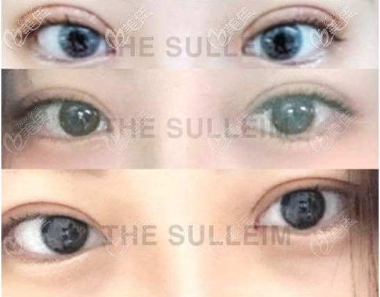 韩国Sulleim心动整形医院双眼皮整形案例三
