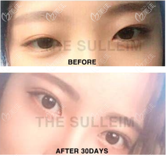 韩国Sulleim心动整形医院双眼皮整形案例四 韩国Sulleim心动整形医院双眼皮整形案例四