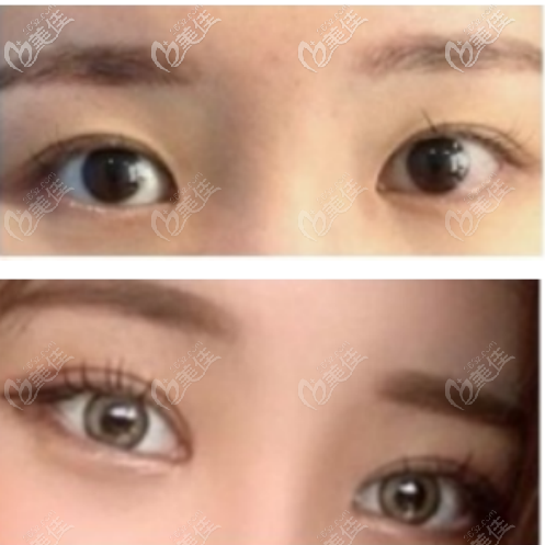 韩国Sulleim心动整形医院双眼皮整形案例五 韩国Sulleim心动整形医院双眼皮整形案例五