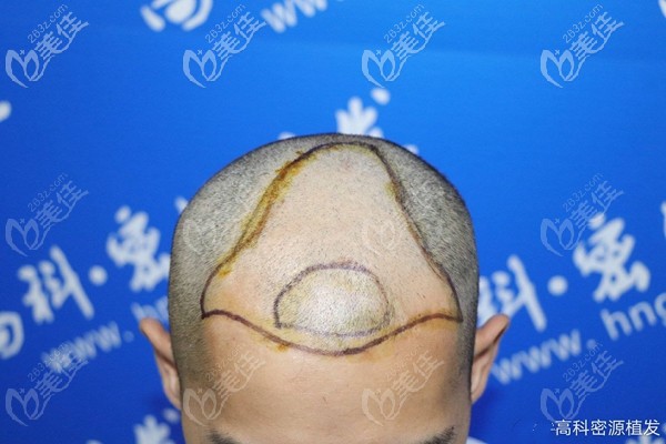 头顶加密植发术前设计图