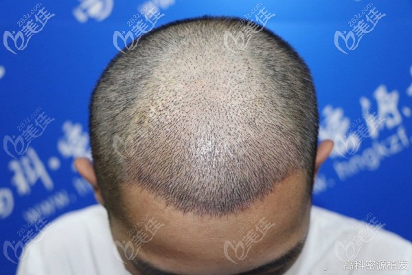 大面积头顶加密需要多少单位?我是植发了三千毛囊并有一个月效果图为证