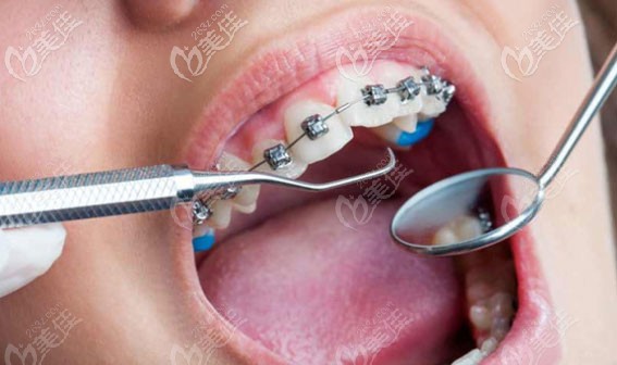 儿童矫正牙齿的较佳年龄