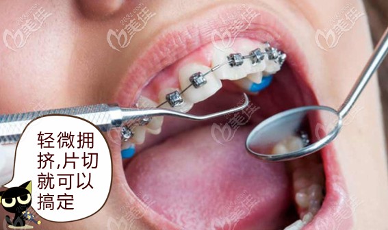 轻度拥挤做片切就可以排齐