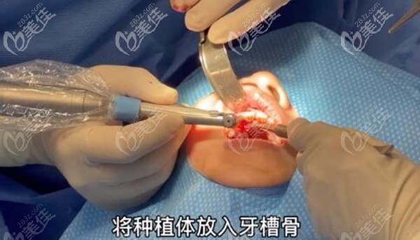 韩国古德莱芙口腔种植一颗前门牙的过程 韩国古德莱芙口腔种植一颗前门牙的过程
