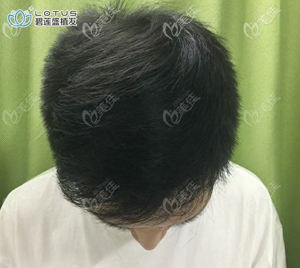 头顶稀疏加密一年后效果图