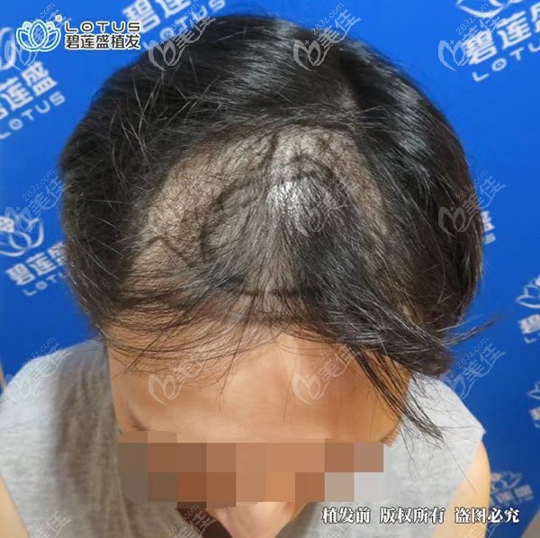 发友植发前设计效果图