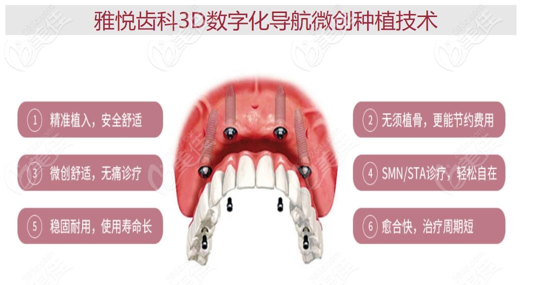 上海雅悦齿科种牙技术