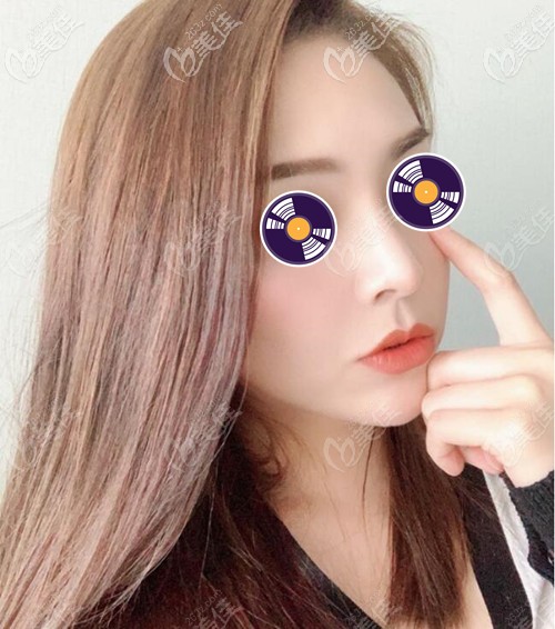 沈绍勇鼻综合术后效果 沈绍勇鼻综合术后效果