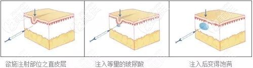 雷医生做玻尿酸除皱的原理 雷医生做玻尿酸除皱的原理