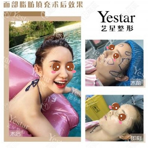 深圳艺星脂肪填充效果对比