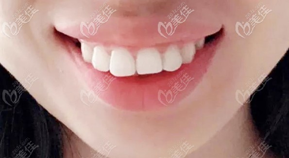 青岛马泷齿科做牙齿矫正的张晗医生案例 青岛马泷齿科做牙齿矫正的张晗医生案例