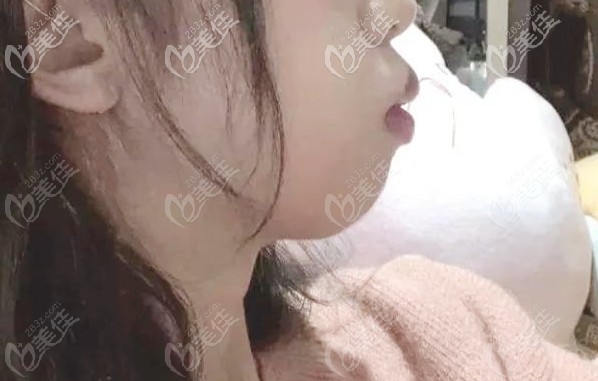 龅牙矫正前的侧貌图 龅牙矫正前的侧貌图