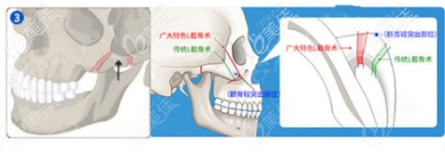 柳超做颧骨整形的优势