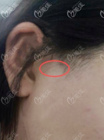 颧骨内推手术耳前切口恢复效果