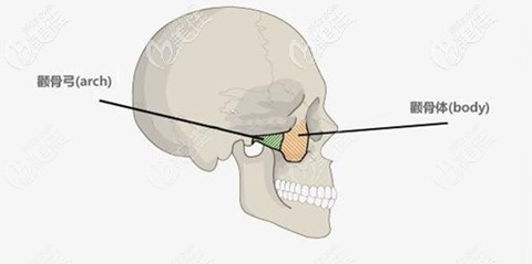 颧骨内推手术会留疤吗？