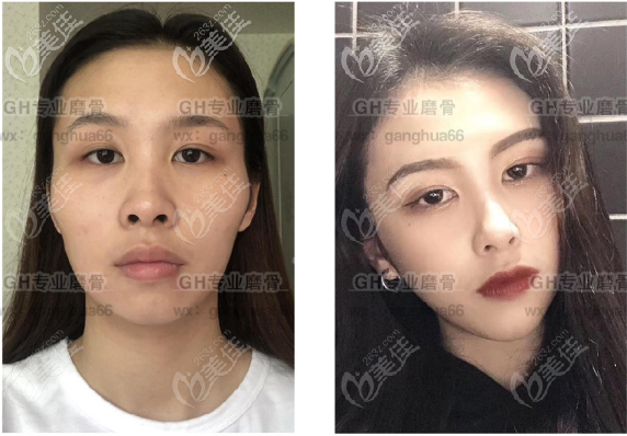 磨骨技术怎么样？从磨骨案例来看磨骨磨的不多风格自然价格不贵