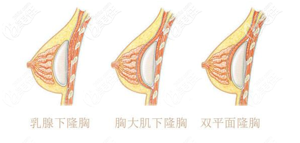 假体隆胸植入包含哪几种层次