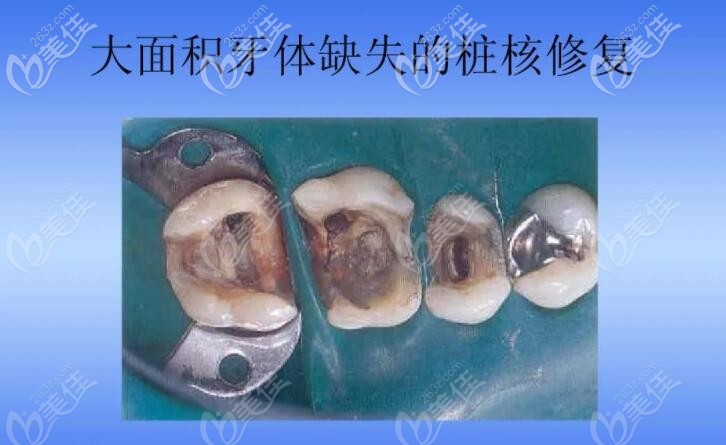 大面积牙体缺损采用金属和纤维桩核进行修复