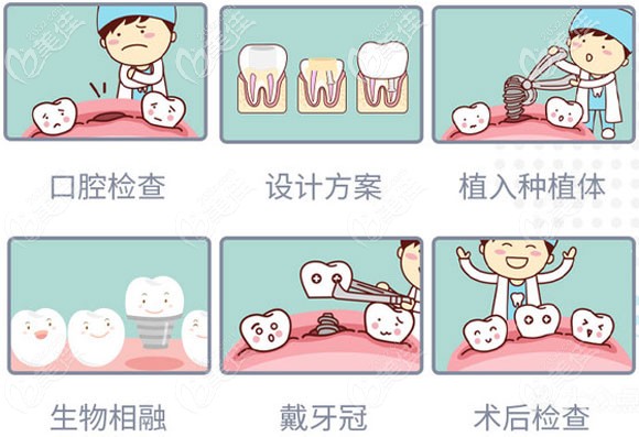青岛马泷齿科的种植牙过程图解