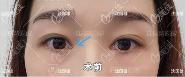 沈国雄眼修复案例术前照 沈国雄眼修复案例术前照