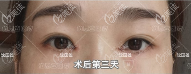 沈国雄眼修复案例术后第三天 沈国雄眼修复案例术后第三天