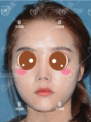 <!--<i data=20240703-sp></i>-->伯思立沈国雄鼻修复真人案例术前正面照 <!--<i data=20240703-sp></i>-->伯思立沈国雄鼻修复真人案例术前正面照