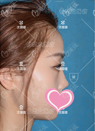 <!--<i data=20240703-sp></i>-->伯思立沈国雄鼻修复真人案例术前侧面照 <!--<i data=20240703-sp></i>-->伯思立沈国雄鼻修复真人案例术前侧面照