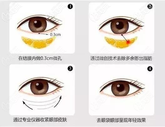 南京美贝尔做不开刀祛眼袋 南京美贝尔做不开刀祛眼袋