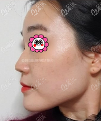 做耳软骨鼻综合前 做耳软骨鼻综合前