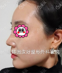 在韩国汝好整形外科做耳软鼻综合没有我想的那么疼 在韩国汝好整形外科做耳软鼻综合没有我想的那么疼