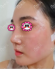 在韩国做的耳软骨鼻综合案例 在韩国做的耳软骨鼻综合案例