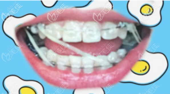 露龈笑牙齿矫正图2