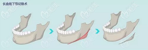 长曲线下颌角手术价格