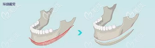 下颌角环切的效果大吗