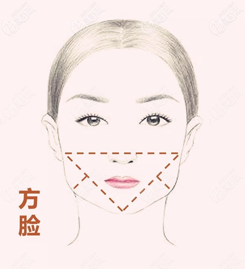 下颌角手术的适应人群