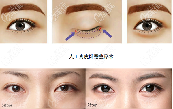 人工真皮瓣卧蚕再造手术过程和步骤