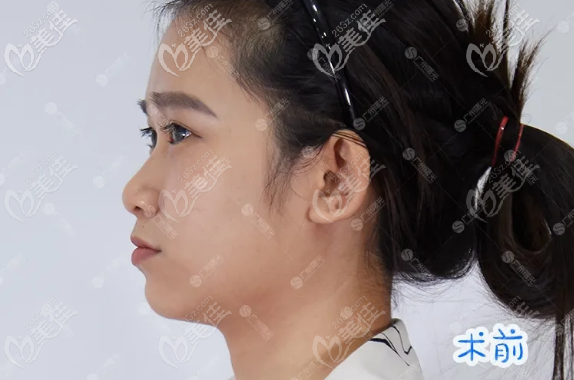 广州曙光双侧耳软骨隆鼻术前照片 广州曙光双侧耳软骨隆鼻术前照片