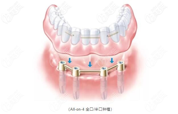all-on-4种植牙 all-on-4种植牙