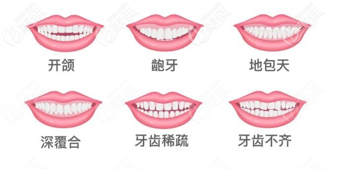 牙齿矫正适应症 牙齿矫正适应症