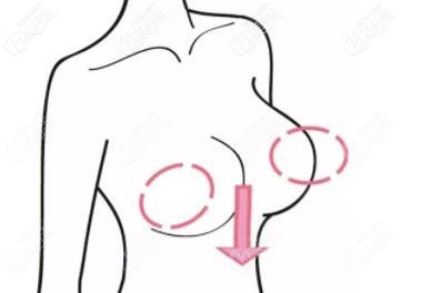 减肥过度导致胸部下垂怎么办