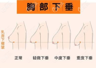 胸部下垂的等级示意图