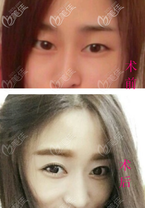 <!--<i data=20240703-sp></i>-->张筠莉医生双眼皮案例二