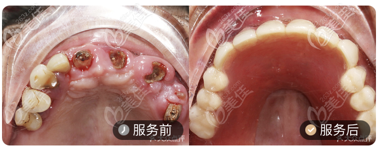 广州德道口腔医院种植牙案例