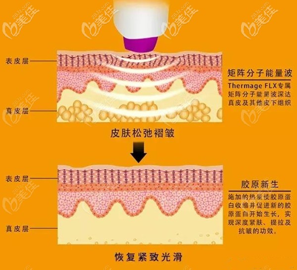 南京康美整形热玛吉除皱