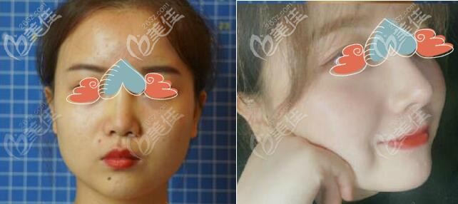 圆脸隆鼻效果图片 圆脸隆鼻效果图片