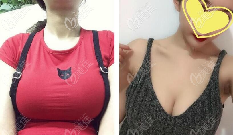 缩胸手术+乳房提升一年后效果图片
